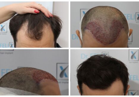 implantul de par la clinica dr felix hair implant