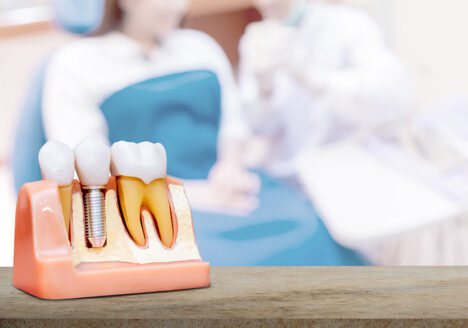 implanturi dentare omniadental