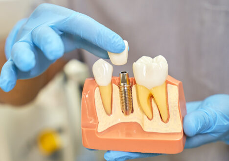implant dentar omnia dental