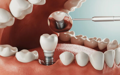 Implant dentar Straumann, solutie premium pentru dinti ficsi si aspect natural